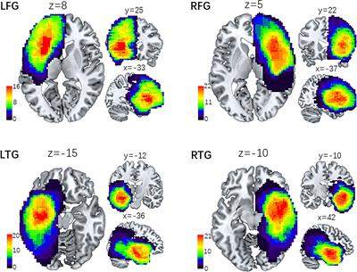 The Functional Reorganization of Language Network Modules in Glioma Patients: New Insights From Resting State fMRI Study